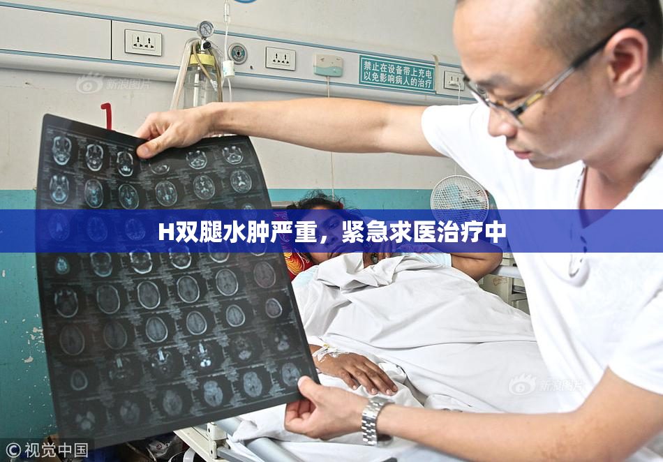 H双腿水肿严重，紧急求医治疗中